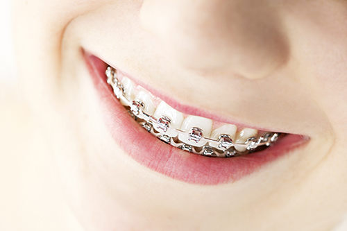 Young women smiling using traditional metal braces as an orthodontic treatment.
