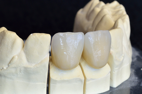Ceramic crowns that encircles tooth structure or a dental implant. This ceramic crown can also be used for discolored or stained teeth. 