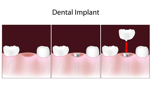 Picture of the process of inserting a dental implant to restore an individual’s mouth and teeth. 