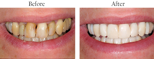 Picture of yellow, stained teeth that need cosmetic dental work and picture of straight white teeth after undergoing cosmetic dental treatment.