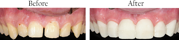 Picture of teeth that need cosmetic dental work, before and picture of teeth after dental correction complete.