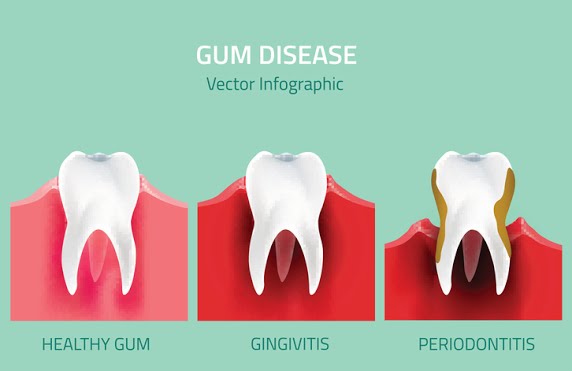 Picture of the signs and various levels of gum disease, which is also known as periodontal disease or gingivitis.