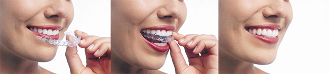 Women placing Invisalign clear aligners. A clear way to straighten your teeth. 