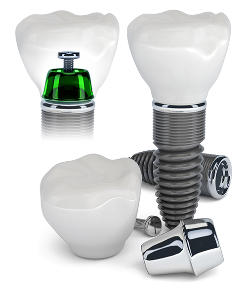 Picture of the titanium dental implant before inserted in the mouth.