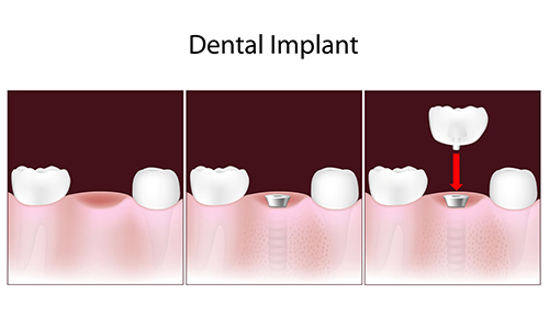 Picture of the process of inserting a dental implant to restore an individual’s mouth and teeth.