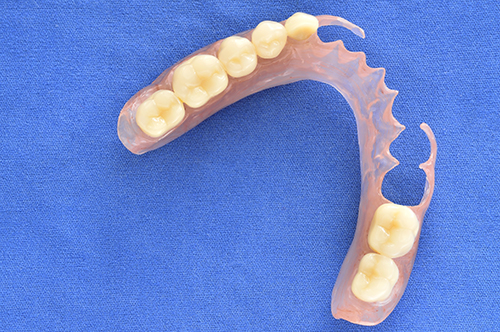 Picture of a denture, or removable bridge, which is used for for the replacement of missing teeth. 