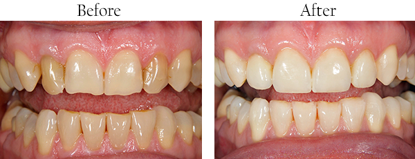 Another picture of yellow, stained teeth that needs cosmetic dental work and picture of straight white teeth after undergoing cosmetic dental treatment.
