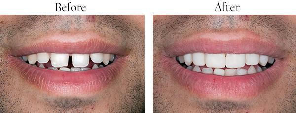 Picture of gap in front teeth that needs correction and picture of the straightened teeth after.