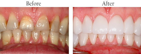 Picture of yellow, stained teeth that need cosmetic dental work and picture of straight white teeth after undergoing cosmetic dental treatment.