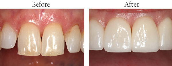 Picture of yellow, badly aligned teeth in need of cosmetic treatment, and picture of white straightened teeth after the procedure's conclusion.