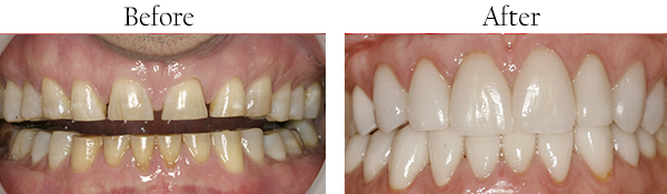 Picture of small, yellow stained teeth that need dental work, followed by a picture of straight white teeth after undergoing cosmetic dentistry treatments.
