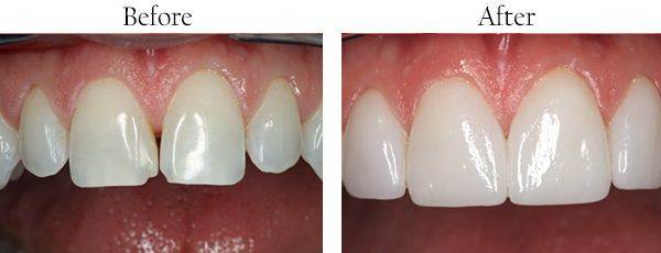 Picture of white front teeth after undergoing cosmetic dental treatment to correct a chipped tooth.