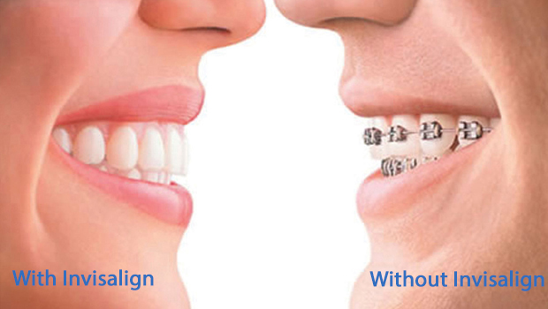 Two individuals, one person with Invisalign clear aligners and one with traditional metal braces. 