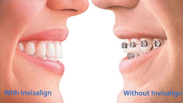 Invisalign Clear Aligners VS Traditional Metal Braces